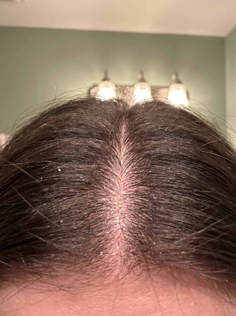 Close-up of a woman's dark hair parted at the scalp showing visible white dandruff flakes against dark roots under warm bathroom lighting