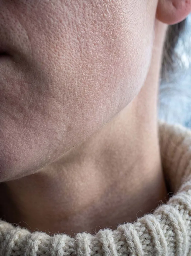 close-up fair skin showing dryness and tightness on cheek in winter natural light